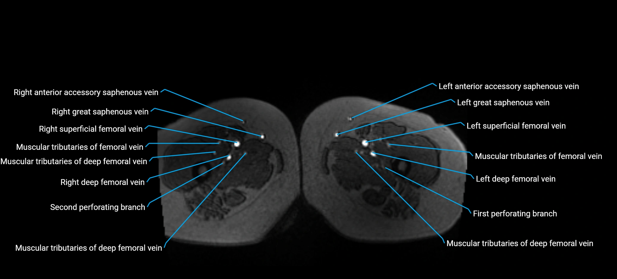 MRV abdomen pelvis & lower limb axial cross sectional anatomy labelled MRI image 228 (1).webp